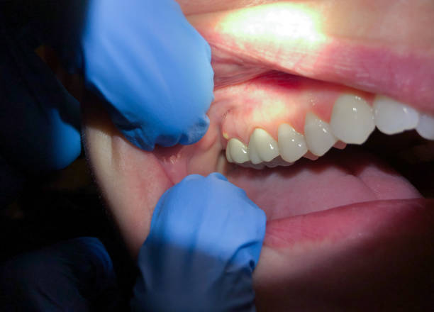 Best Emergency Dental Care for Abscessed Tooth in Fox Chase, PA